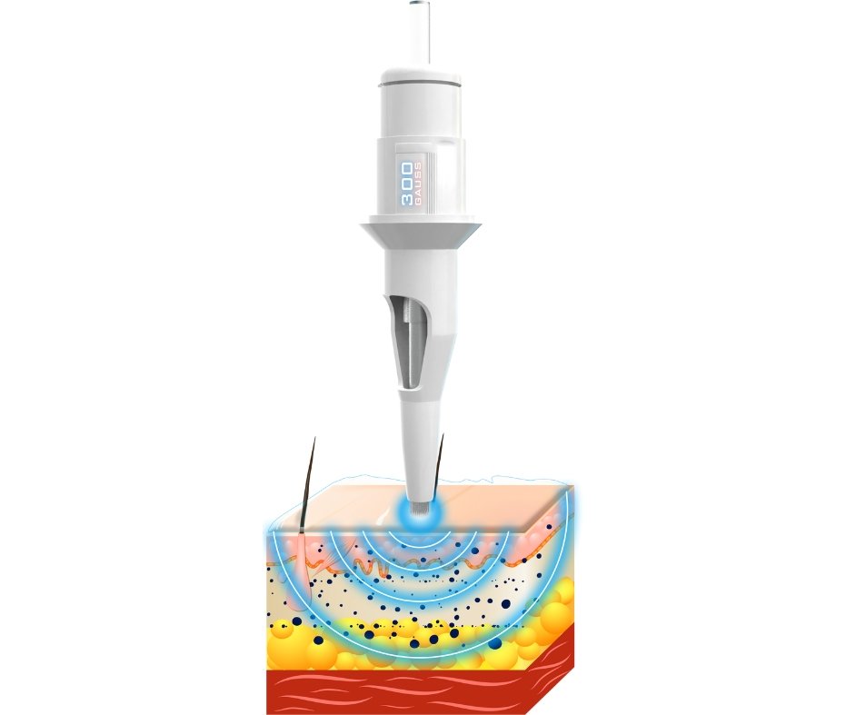 Non-Invasive Cosmetics needles 132 (Used for Icy Lips)